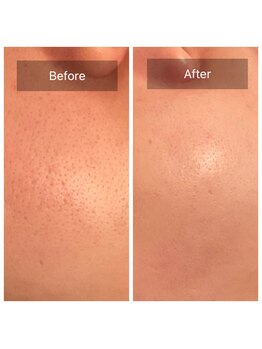 リュミエール デスポワール(Lumiere d'espoir)/毛穴洗浄＋ハーブピーリング