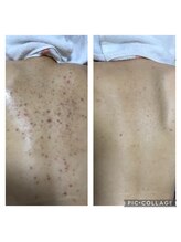 オアジスパ(Oasi Spa)/DTありハーブ４回Beforeafter