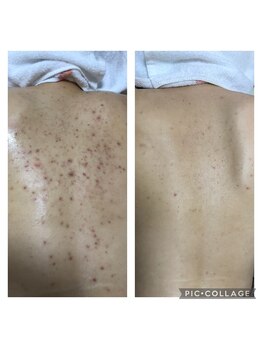 オアジスパ(Oasi Spa)/DTありハーブ４回Beforeafter