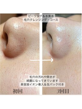 アンフルール(An Fleur)/水素水ハイドロクレンジング