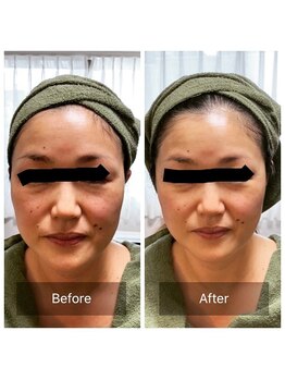 シンシア(sincere)/大人のリフトアップケア/美顔