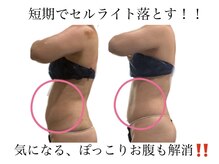 痩身革命 大宮店/施術写真（痩身）