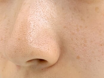 サロン ド ユニ(SALON DE UNI)の写真/お肌のお悩み何からケアすれば？！まずは毛穴洗浄×顔脱毛がおすすめ♪