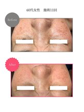 ボータン 恵(Beau Temps)/ウルトラ光トーニング/シミ改善