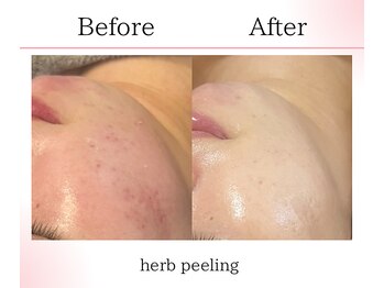 サロンツキ(salon tuki)/ハーブピーリング症例