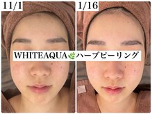 ホワイトアクア 福岡天神店(WHITE AQUA)/ハーブピーリングビフォー