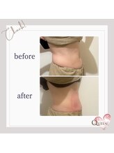 クイーン(QUEEN)/脂肪冷却