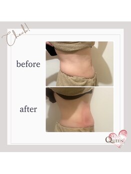 クイーン(QUEEN)/脂肪冷却