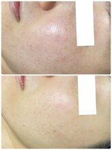 ミュベル(Myubelle)/肌の凹凸改善