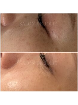 サロンドジョリー/ハーブピーリング３回