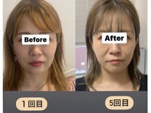エレグラム(Elegram)/小顔矯正　施術