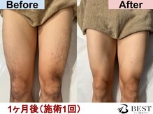ベスト 藤枝店(BEST)/ひざ上　ビフォーアフター