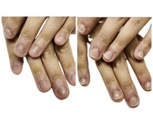 ブルームブルーム(BLOOMブルーム)/バレずに深爪矯正