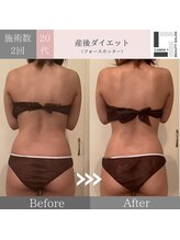 ルアナ プラス(Luana＋)/痩身/2回施術