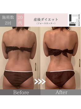 ルアナ プラス(Luana＋)/痩身/2回施術