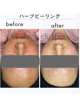 シフォン(Chiffon)/ハーブ 赤み、ニキビケア症例