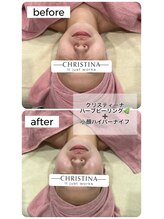 レイ(Ray)/ハーブピーリング