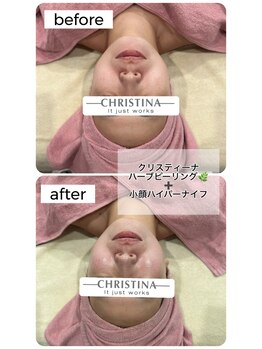 レイ(Ray)/ハーブピーリング