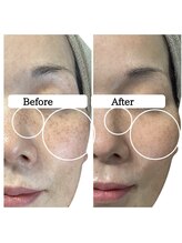 ル ボヌール 伊那店(le bonheur)/シミケア＆エクソソームハーブ