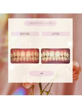 プラスビーセルフ(+b self)/ホワイトニングビフォーアフター
