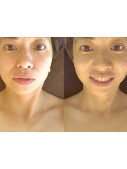 小顔になりたい