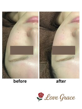 ラブグレイス(Lovegrace)/光フェイシャル