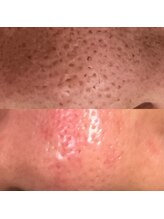 ナチュラ 諫早店(NAchuRA)/毛穴洗浄