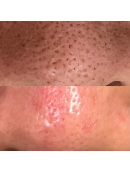 ナチュラ 諫早店(NAchuRA)/毛穴洗浄