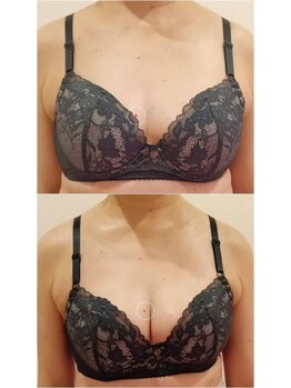 ククー(coucou)/1回施術でのバストライン変化