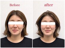 ぶんご整骨院 下郡院の雰囲気（電気美容鍼＋小顔   before & after）