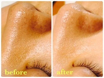 ベルドア(Bell Door)/ピーリング×ビタミン導入