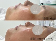 リル(relle)の雰囲気（肌悩みのある方へ(ガリレオピーリング施術)）