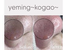 エミング(yeming)の雰囲気（毛穴エクストラクションで長年の毛穴お悩み/つまり/黒ずみ解決！）