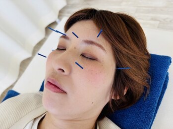 ミヤビ(MIYABI)の写真/≪目元すっきり!≫鍼×マッサージで眼精疲労を根本ケア♪深部のコリに直接アプローチ!【お子様同伴OK】