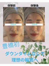 エノア(ENOA)/豊橋/輪郭矯正小顔コルギ