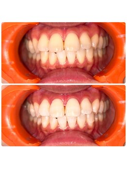 コナホワイトニング 神保町/ホワイトニング