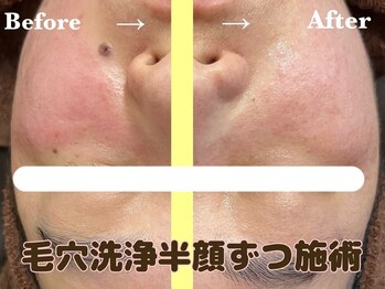 ミノア 熊本店(MINOA)/赤み改善/毛穴ケア