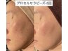 【シミ・しわ・たるみケア】プロセルセラピーズトリートメント ¥35,000