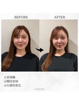 リベルタ鍼灸整骨院 なんば店(Liberta鍼灸整骨院)/美容鍼はヘッドスパ付きですか?