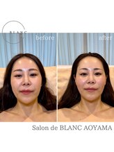 サロン ド ブラン アオヤマ(Salon de BLANC AOYAMA)/BLANC式小顔60分コース