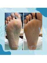 巻き爪補正店 秋葉原店/【トータルケア（足裏）】