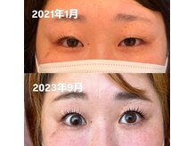 リッシュ(riche)/ダブルアイリフト