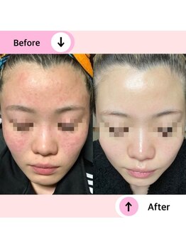 アネラ(ANELA)/私もこんなに肌が変わりました!