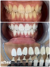 エクシアホワイトニング 札幌中島公園店/Before After［ホワイトニング］
