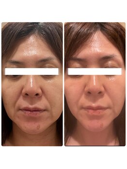 アイビー(aibe:)/＜肌質改善＞フェイシャル