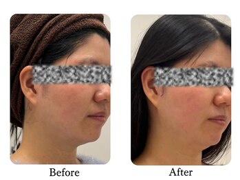 ラディアント たまプラーザ/フェイスラインのもたつき改善