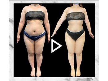 エステティック エイチアンドビー 大和店(H&B)/ビフォーアフター