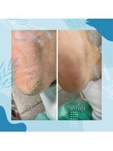 巻き爪補正店 秋葉原店/【踵の角質】