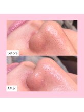 ホワイトラボ 新潟万代(White labo)/【施術例】ハイドロフェイシャル