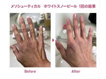 あきらめていた手の甲にも効果大！気になる首にもできます♪